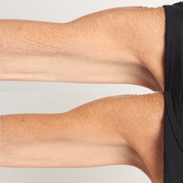 High Potency Hyalurionic Intensive Body Therapy*